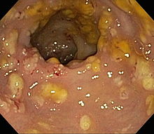 Pseudomembranous colitis