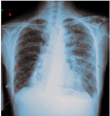 Kerley lines in Congestive heart failure