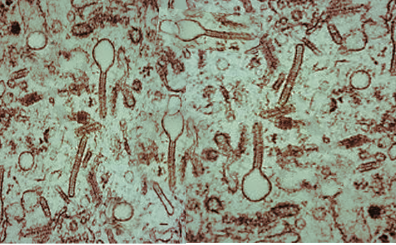 <p>Histiocytosis Microscopy