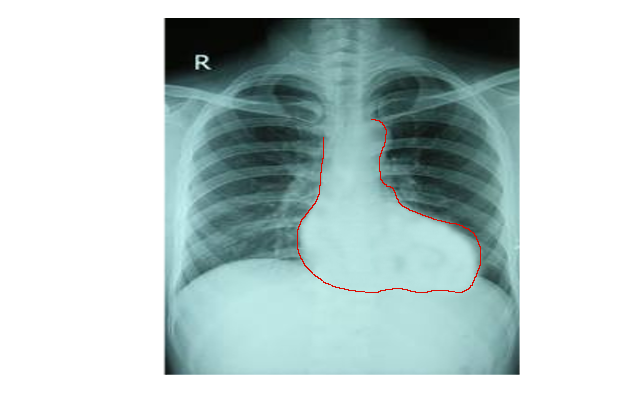 tetralogy of fallot