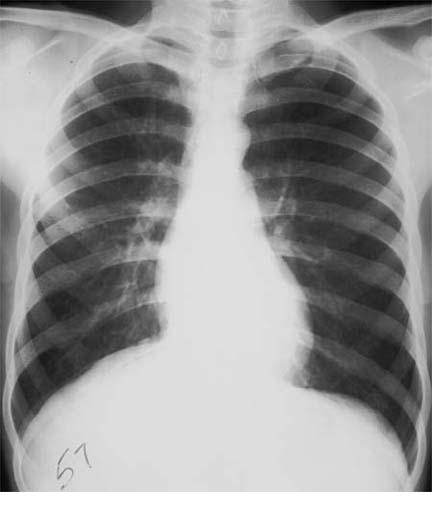 upper lobe pneumothorax