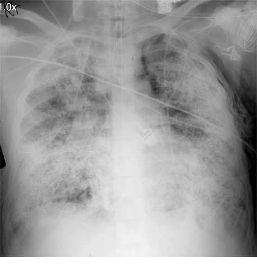 subcutaneous emphysema