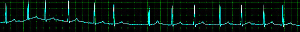 atrial fibrillation