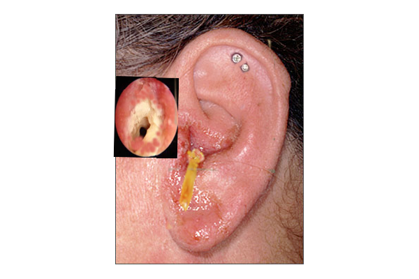 otitis externa