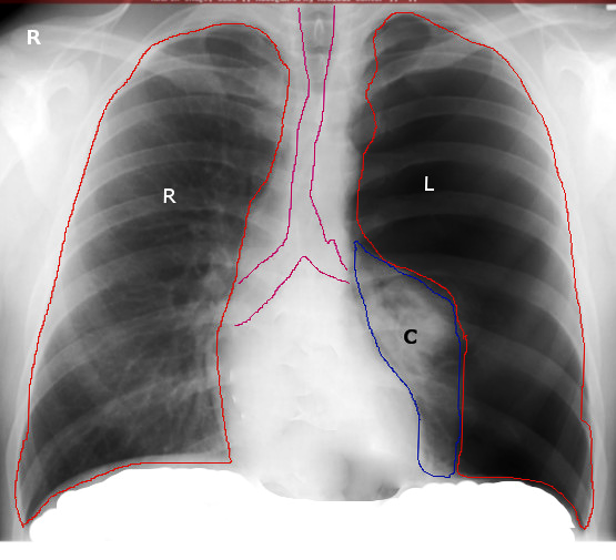 Tension pneumothorax