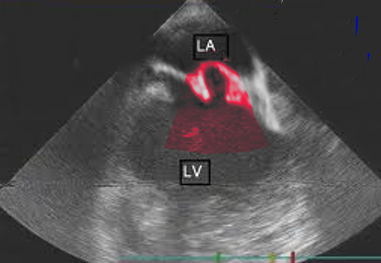 mitral valve prolapse echo