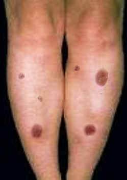 erythema nodosum