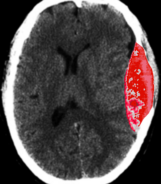 epidural hematoma after trauma