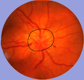 optic neuritis in multiple sclerosis