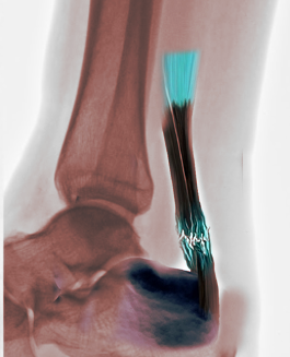 achilles tendon rupture