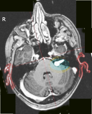 acoustic neuroma