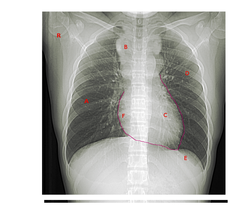 Anterior mediastinal mass