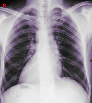 dextrocardia chest x-ray