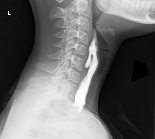 Zenker diverticulum Barium