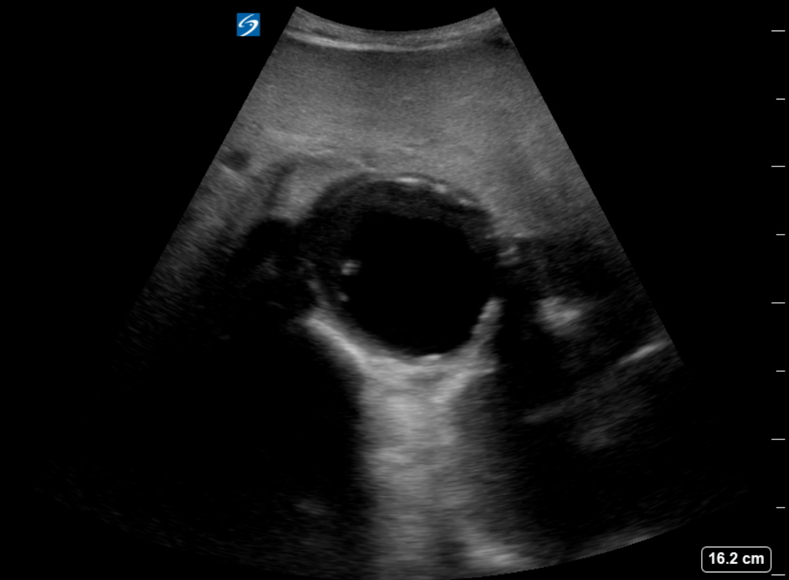 Figure 3. Abdominal Aortic Aneurysm.