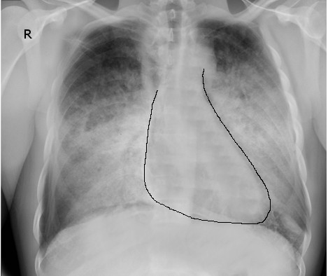 congestive heart failure