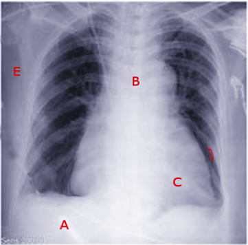 Central line pericardium