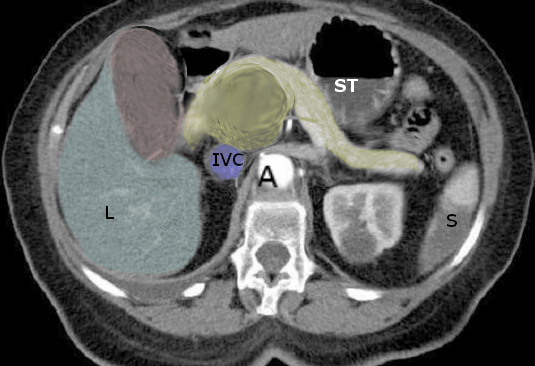 Pancreatic cancer- courvosier sign