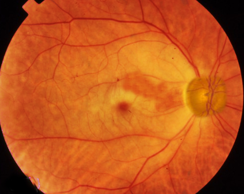 central retinal artery occlusion