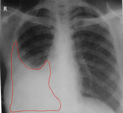 Right sided pleural effusion