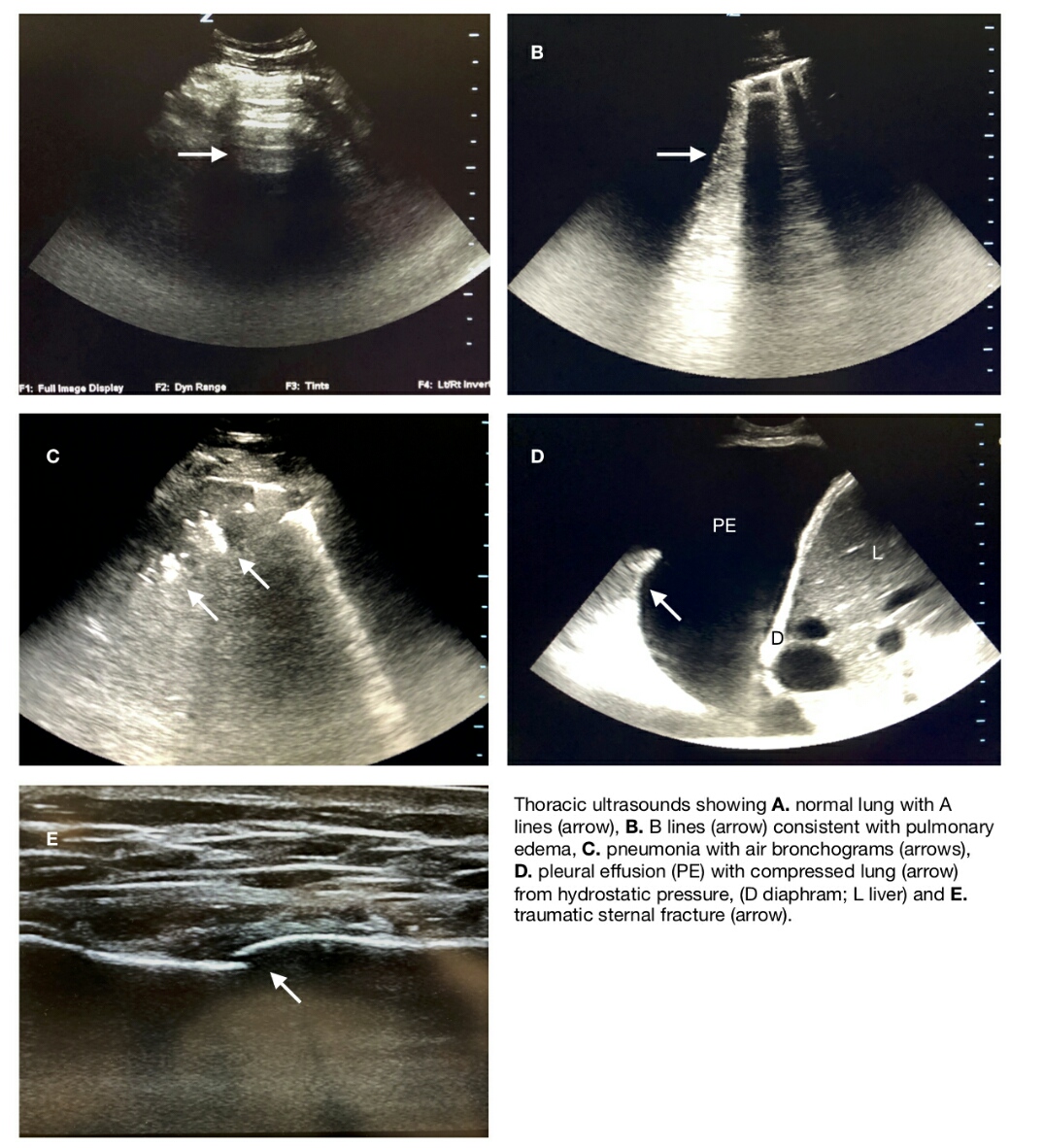 Thoracic Ultrasound