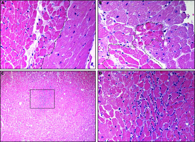 Figure 1 Small foci of coagulative necrosis can be recognised on haematoxylin and eosin (H&E) stained sections: ischaemic myocytes typically show the hypereosinophilia that characterises early phases of coagulative necrosis