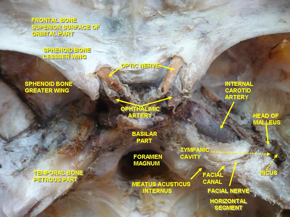 Optic nerves arising from optic canals