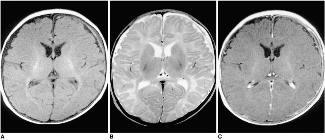 Shaken Baby Syndrome MRI
Chronic subdural hematoma (SDH) in a three-month-old female patient 
A T1-weighted image shows mainly low-signal SDH, with a high signal focus in the left frontal area