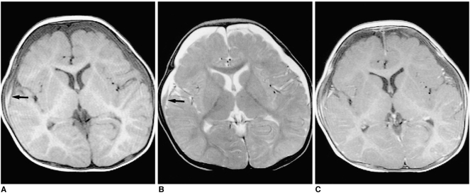 Shaken Baby Syndrome MRI
Chronic Subdural Hematoma in an eight-month-old male patient
A; T1-weighted image shows low-signal SDH in both frontal areas