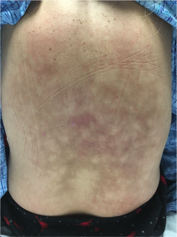 Erythema ab igne of the back