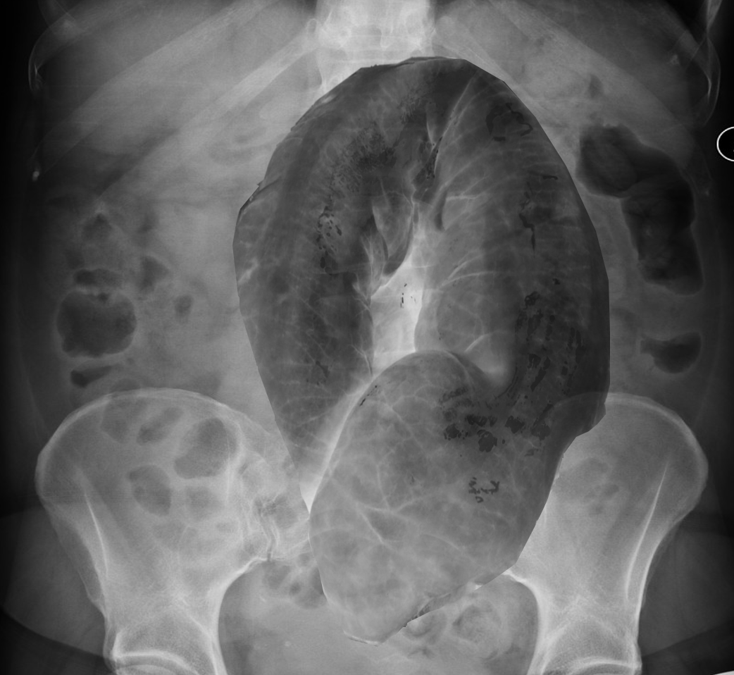 Sigmoid volvulus