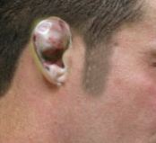 Cauliflower ear