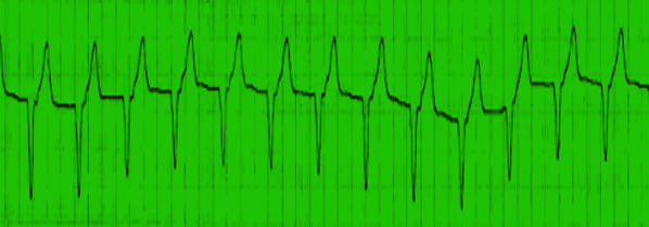 Ventricular Tachycardia, [SATA]