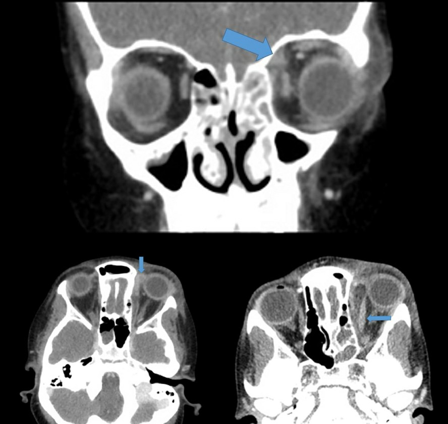 Orb Cell, CT Scan