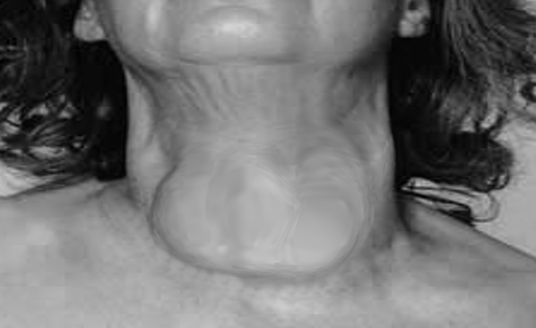 goiter in a female