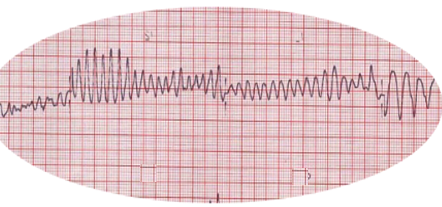 Ventricular fibrillation