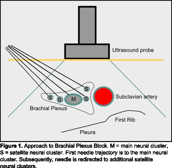 Approach to Supraclavicular block