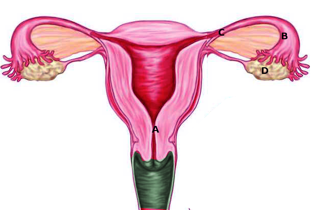 Ectopic pregnancy