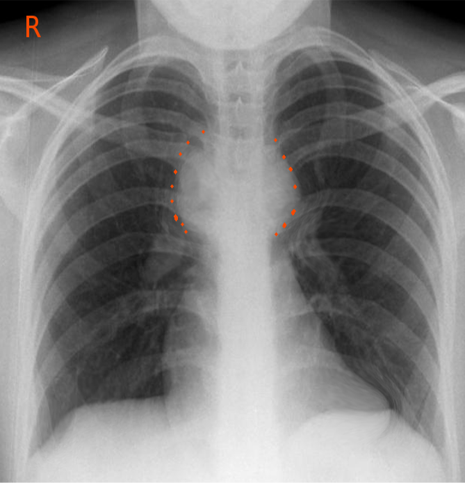 Mediastinal adenopathy