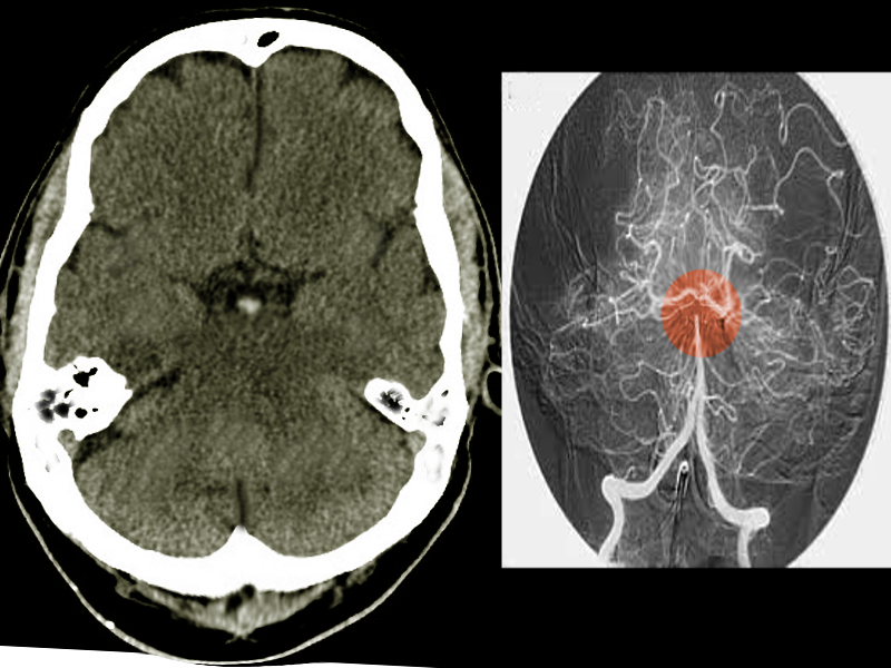 Basilar artery infarct