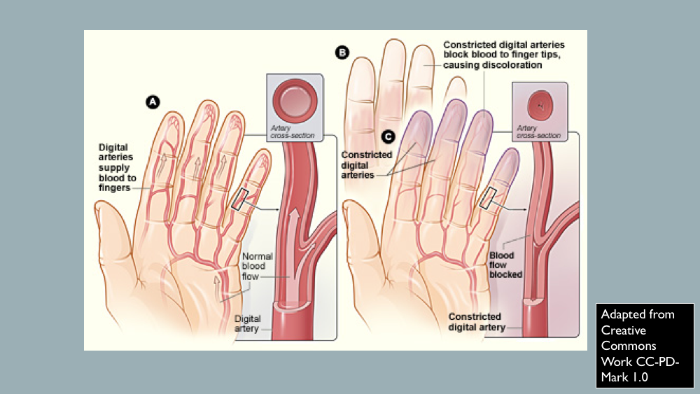 Raynaud's Phenomena