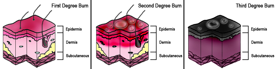 Diagram of Burn Degrees