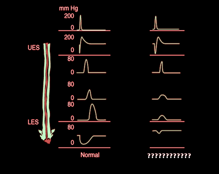 <p>Manometry in a Patient With Chagas</p>