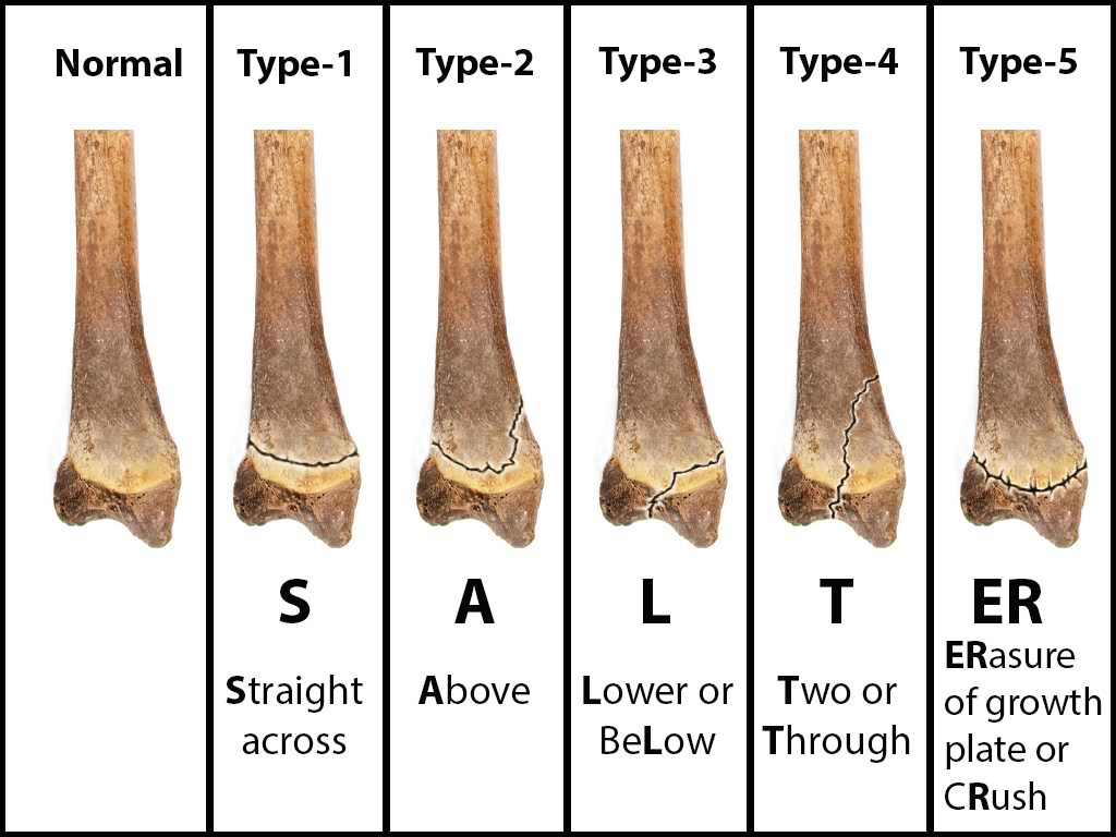 Salter-Harris, Types I-V