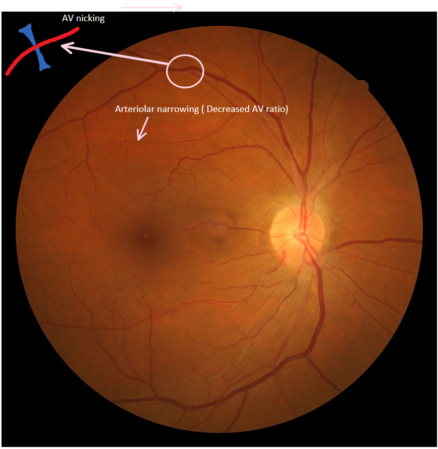 Hypertensive Retinopathy