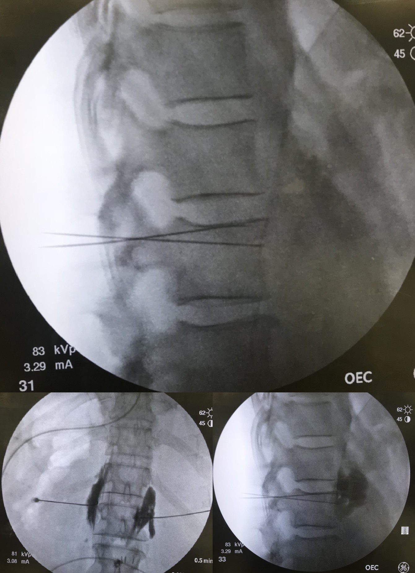 Neurolytic Celiac Plexus Block via Posterior Approach
Lateral View (1,2) and AP view (3)