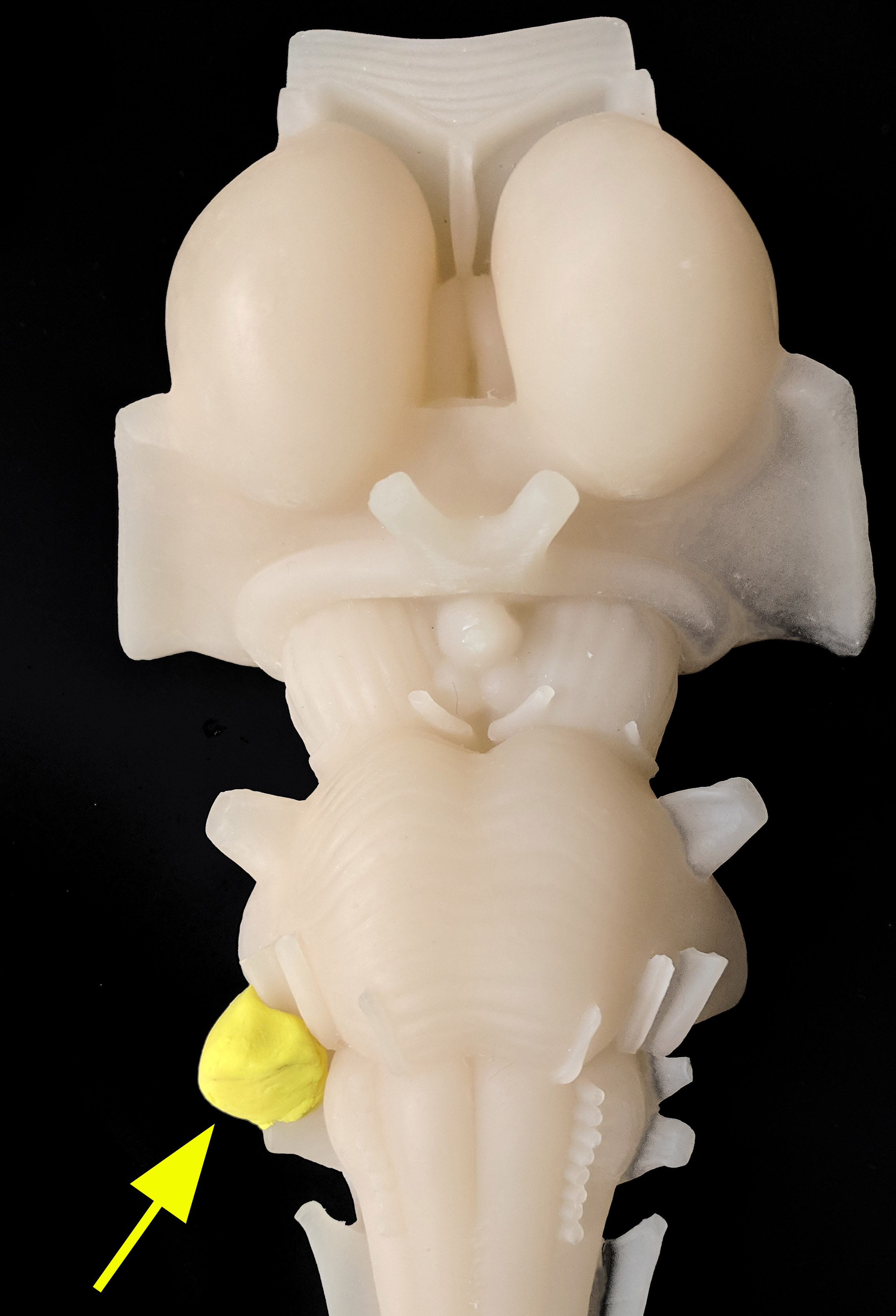 Location of an acoustic neuroma on a brain-stem model.