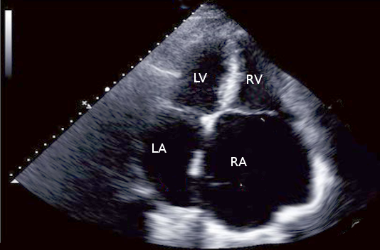 Echo Tricuspid atresia