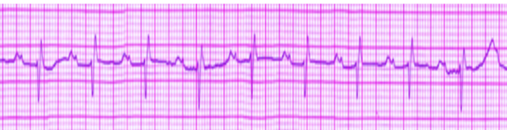 ECG left atrial enlargement