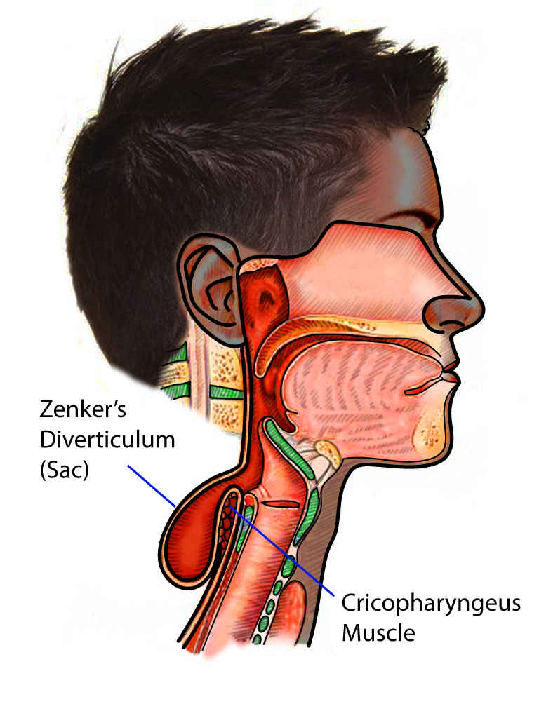 Zenker Diverticulum